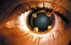 7506(6PR): ERG-Jet Contact Lens Electrodes (6 Pairs) Close up of ERG Jet eye electrode on patient's eye